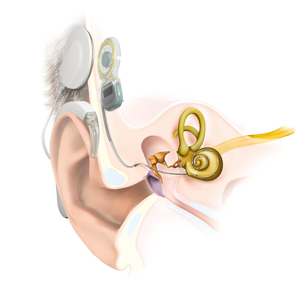 Kaulard-Akustik-Cochlea-Implantat-1-Wissen Kaulard-Akustik-Cochlea-Implantat-1-Wissen